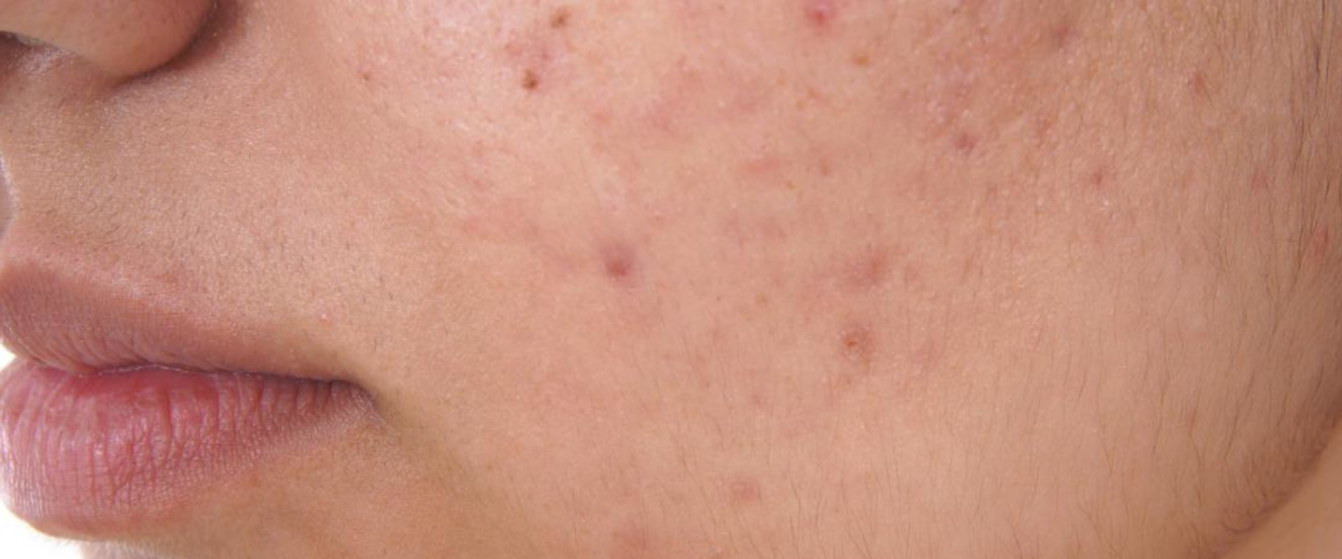 Understanding Acne and Blemishes