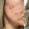 Before-and-after photos of various skin concerns