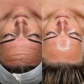 Showcasing the Benefits and Results of HydraFacials